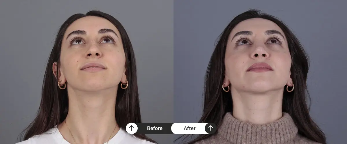 Burun estetiği öncesi ve sonrası – 32