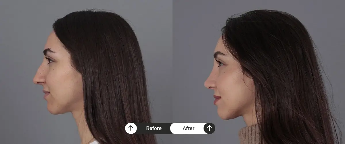 Burun estetiği öncesi ve sonrası – 27