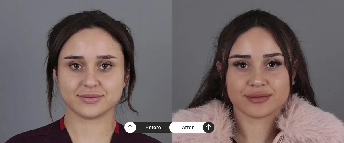 Burun estetiği öncesi ve sonrası – 38