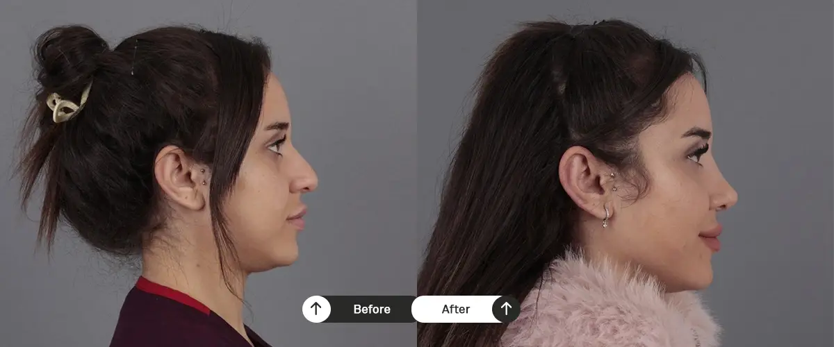 Burun estetiği öncesi ve sonrası – 36