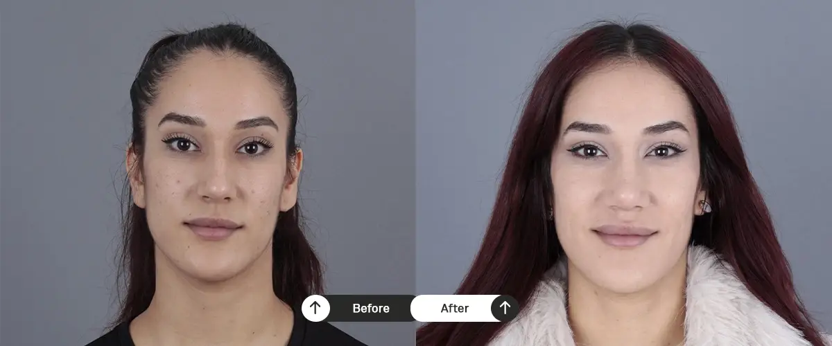 Burun estetiği öncesi ve sonrası – 20